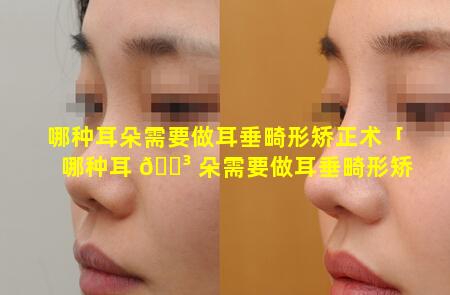 哪种耳朵需要做耳垂畸形矫正术「哪种耳 🌳 朵需要做耳垂畸形矫 🦋 正术呢」